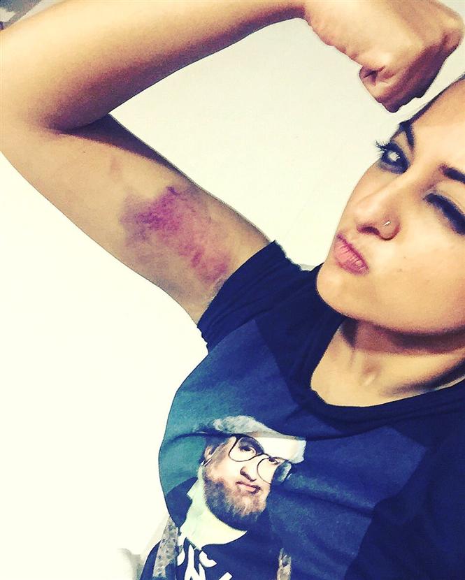 Sonakshi Sinha got injured on the sets of 'Akira'